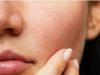 Bít tắc lỗ chân lông gây mụn, cần làm gì để khắc phục