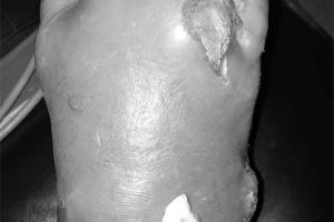 Mắc bệnh Gout đau đớn sau bữa tiệc uống bia, hải sản
