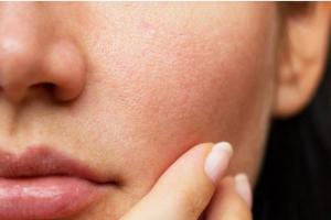 Bít tắc lỗ chân lông gây mụn, cần làm gì để khắc phục