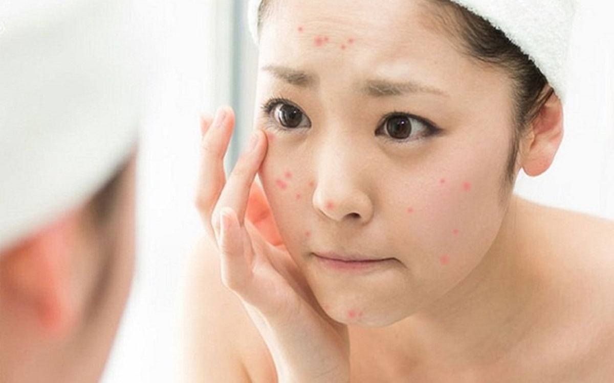Muốn trị mụn thành công, đừng bỏ qua 9 điều này