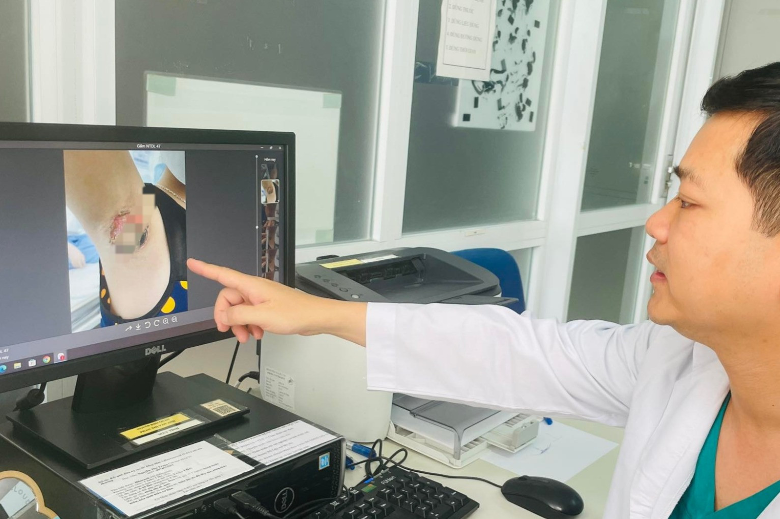 Đốt điện chữa mùi mồ hôi tuổi dậy thì khiến 2 nách bị bỏng nặng