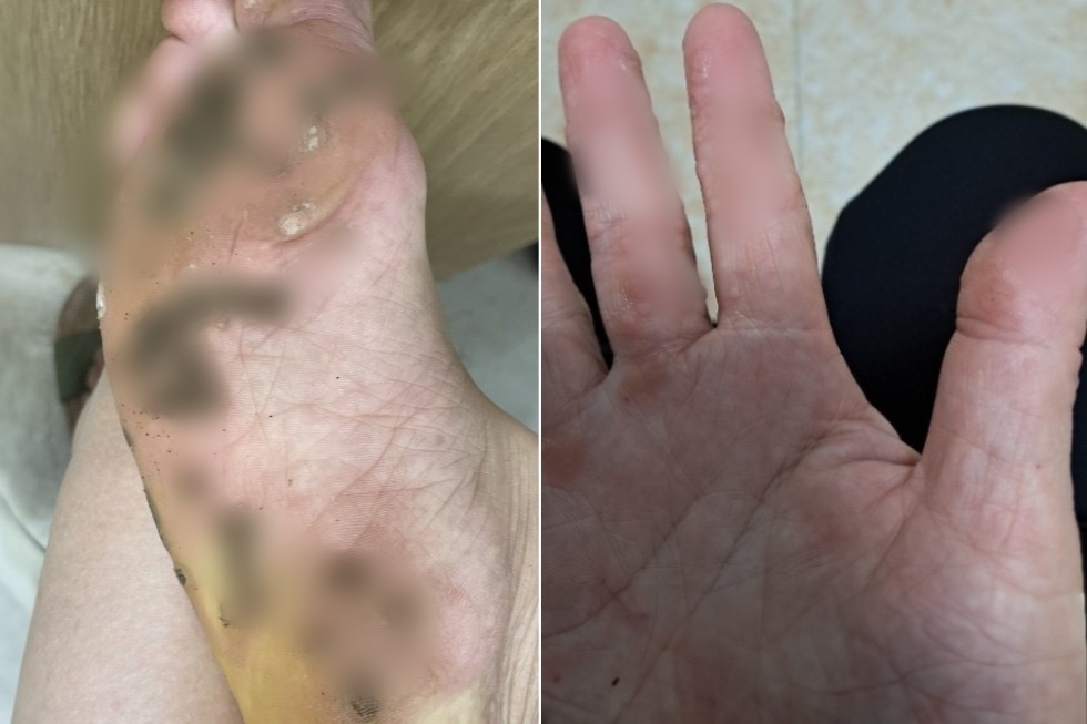 Gia đình 4 người bị hàng trăm mụn cóc do… đi chung dép