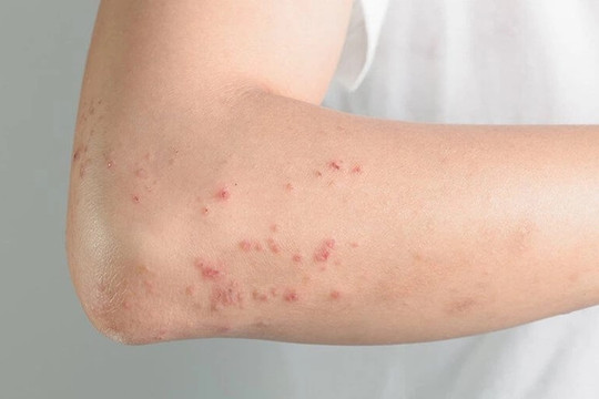 Nguy cơ dị ứng nặng khi sử dụng thuốc nam