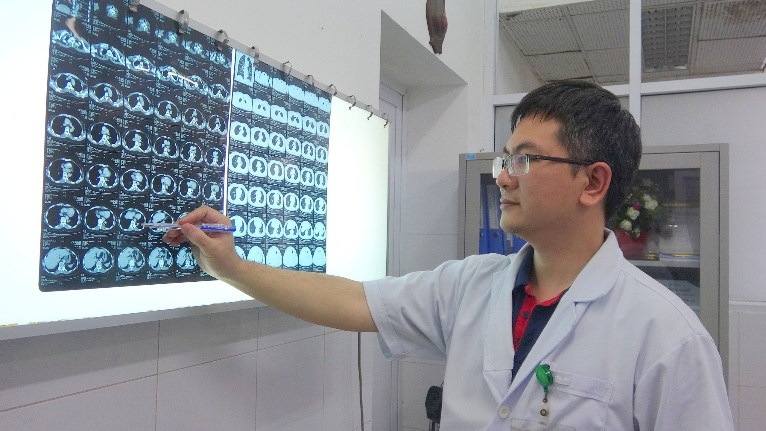 Phẫu thuật cắt bỏ phổi biệt lập có mạch nuôi lớn hiếm gặp