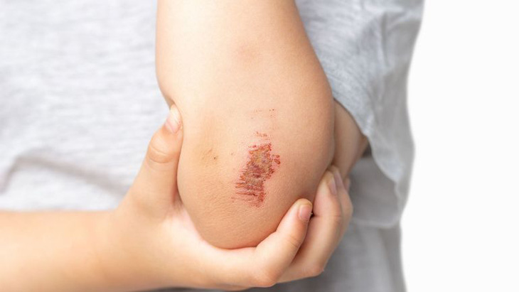Phát hiện đột phá về quá trình liền sẹo