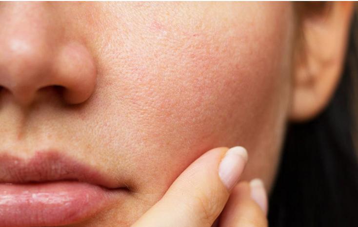 Bít tắc lỗ chân lông gây mụn, cần làm gì để khắc phục
